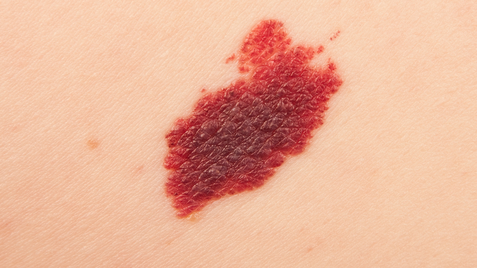 Diagnosi Melanoma