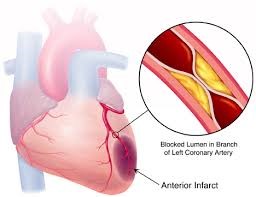 riconoscere-infarto