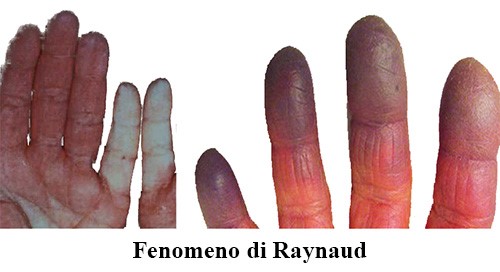 sclerodermia del pene